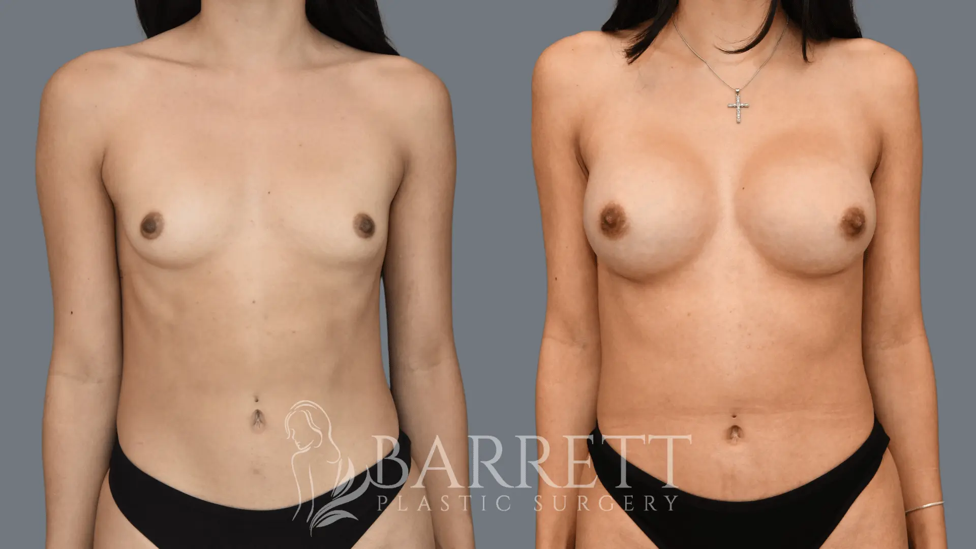 Dr. Neusner Barrett Plastic Surgery Before and After Type: Sientra Smooth Silicone Size: 380cc (Bilateral) Profile: Moderate Profile Plus