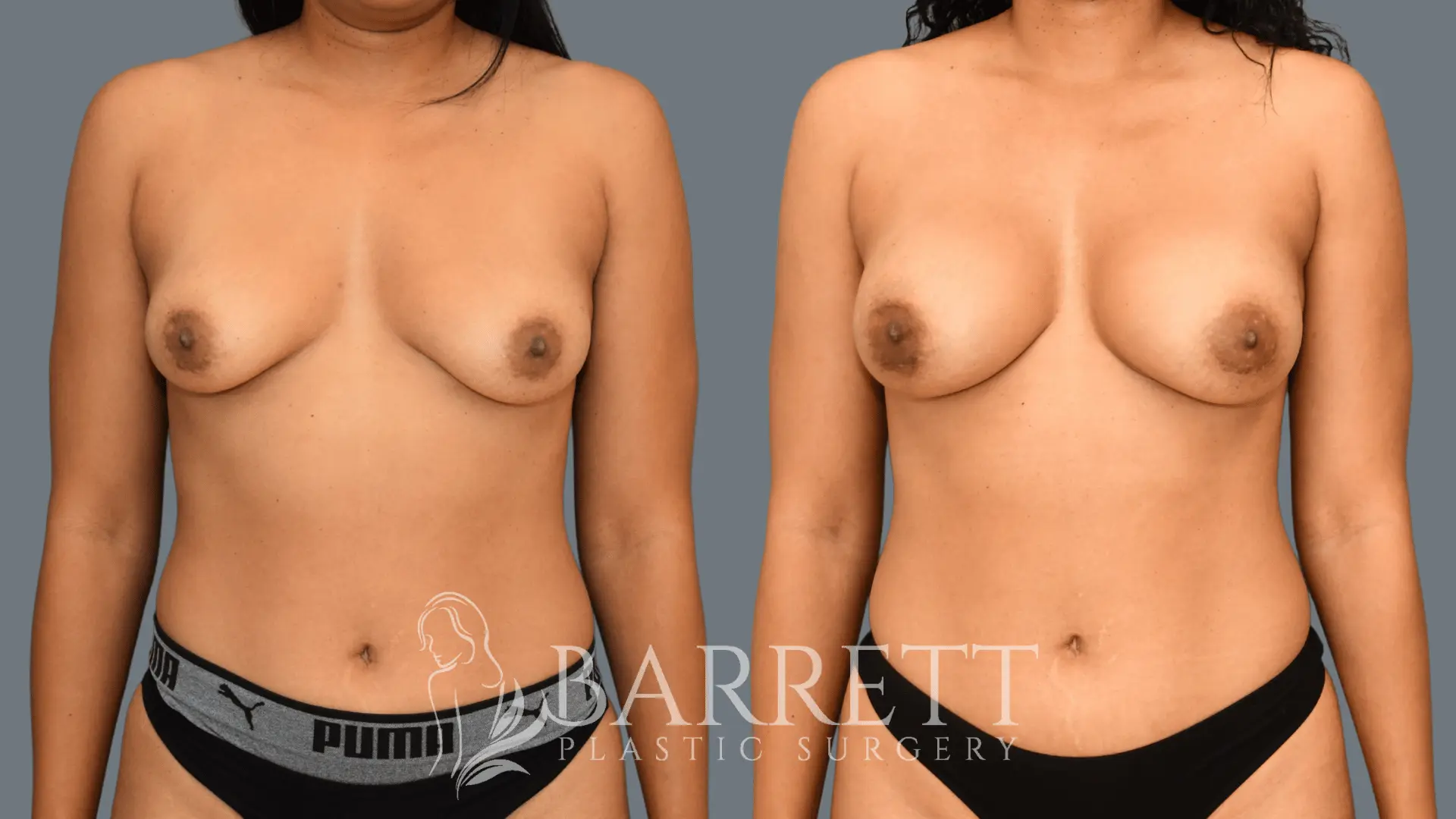 Sientra Silicone Size: 285cc Implants Profile: Moderate Profile Plus Breast Augmentation before and afters Dr. Neusner with Barrett Plastic Surgery