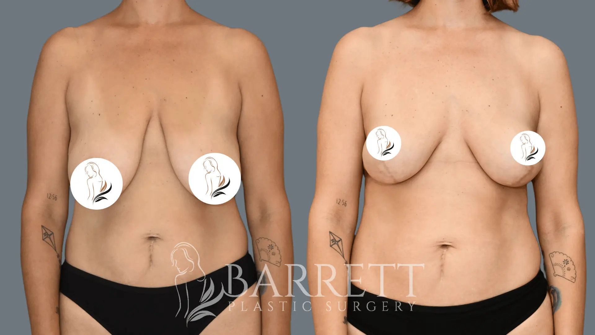 Breast Reduction and Lift with Dr. Neusner from Barrett Plastic Surgery