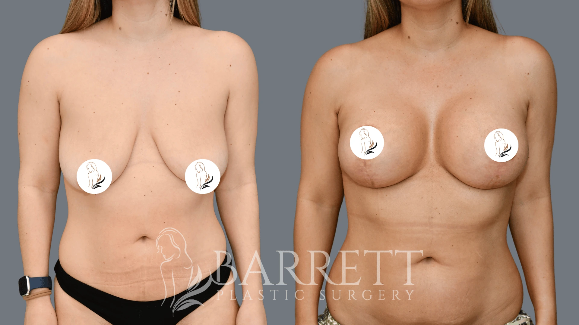 Breast Lift with Implants before and after 6 weeks post operation with Dr. Neusner at Barrett Plastic Surgery. 350cc Mentor Implants